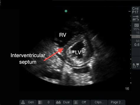 d sign cardiac ultrasound.